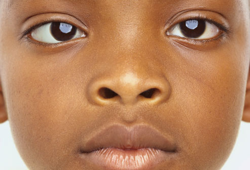 Child with an eye alignment difference, from the original Phoenix article